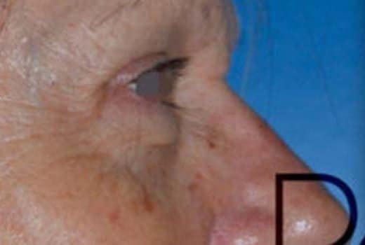 Les yeux d un homme agee de profil droit avant blepharoplastie esthetique |Dr Aimard Lyon