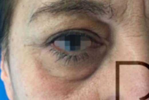 Oeil droit d un homme avant blepharoplastie.. chirurgie esthetique | Dr Aimard Lyon