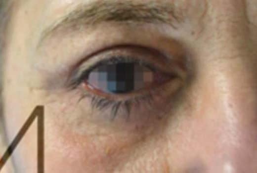 Oeil droit d un homme apres blepharoplastie réussie | Dr Aimard Lyon