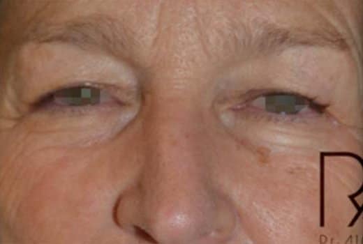 Les yeux d un homme profil face apres blepharoplastie | Dr Aimard Lyon