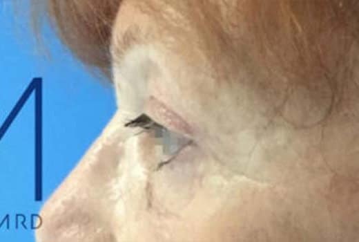 Oeil de femme profil gauche apres blepharoplastie | Dr Aimard Lyon