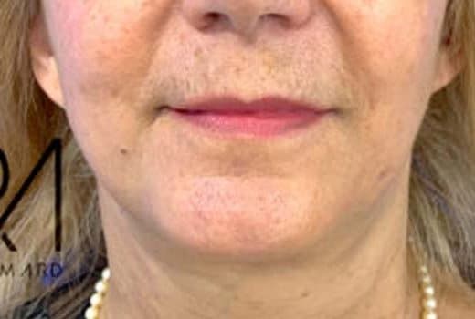Partie inferieure du visage d une femme apres lifting cervico facial | Dr aimard Lyon