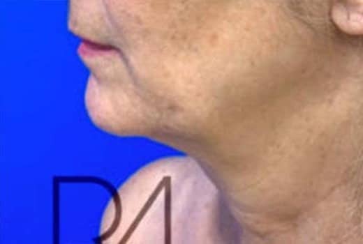 la joue gauche d une femme avant lifting cervico facial. chirurgie du visage | Dr aimard Lyon
