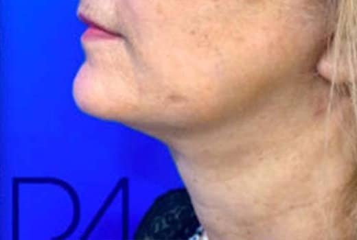 la joue gauche d une femme apres lifting cervico facial | Dr aimard Lyon