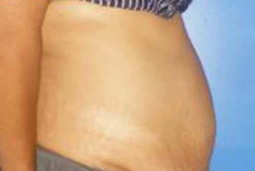 Ventre de femme avant abdominoplastie. chirurgie esthetique de la silhouette| Dr Aimard Lyon