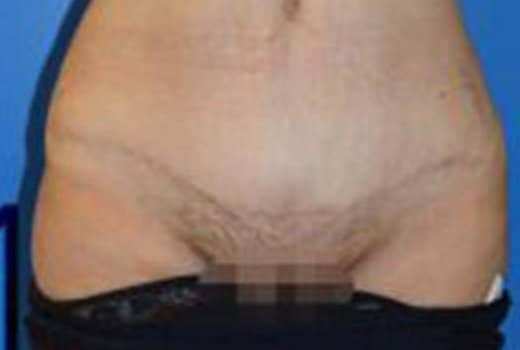 Ventre de femme apres abdominoplastie. chirurgie esthetique de la silhouette | Dr Aimard Lyon