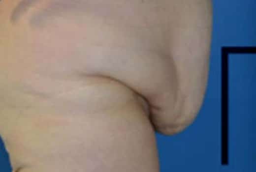 Ventre de femme avant chirurgie esthetique de la silhouette. Adominoplastie | Dr Aimard Lyon