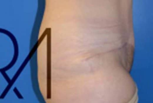 Ventre de femme apres abdominoplastie. chirurgie esthetique de la silhouette | Dr Aimard Lyon
