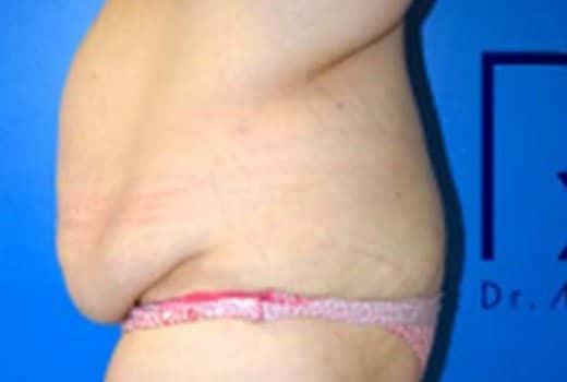 Ventre de femme avant chirurgie esthetique de la silhouette. Abdominoplastie | Dr Aimard Lyon