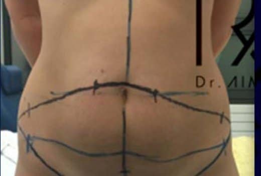 Ventre de femme avant abdominoplastie. chirurgie esthetique de la silhouette | Dr Aimard Lyon