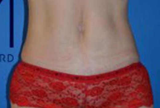 Ventre de femme apres. chirurgie esthetique de la silhouette. Abdominoplastie | Dr Aimard Lyon