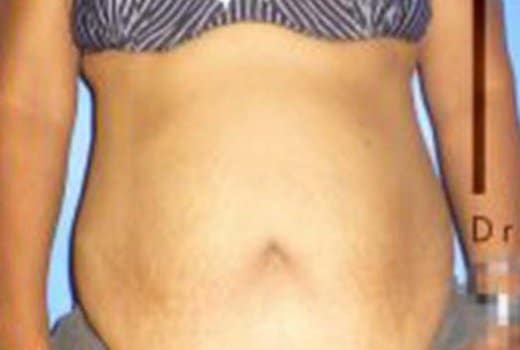 Ventre de femme avant abdominoplastie. chirurgie esthetique de la silhouette | Dr Aimard Lyon