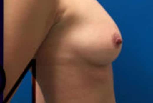 Seins de femme de profil droit apres augmentation mammaire par lipostructure | Dr Aimard Lyon