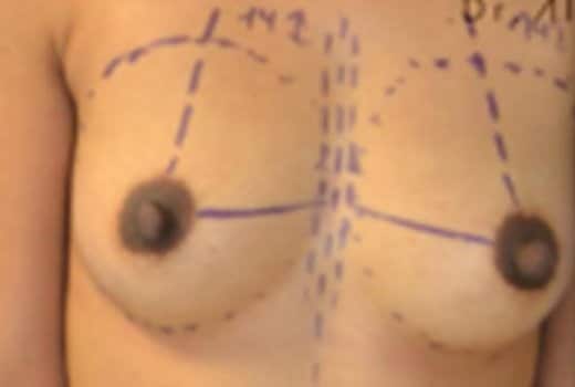 Seins de femme de profil face avant chirurgie du sein. Augmentation mammaire par prothese| Dr Aimard Lyon