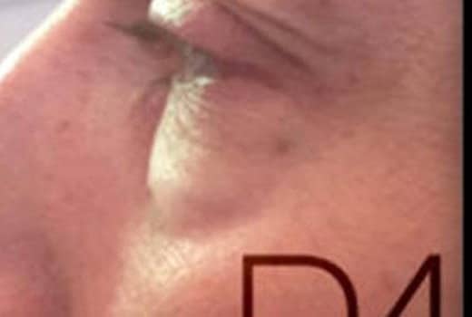 Oeil d un homme de profil gauche avec les cernes gonflee avant correction des cernes | Dr Aimard Lyon