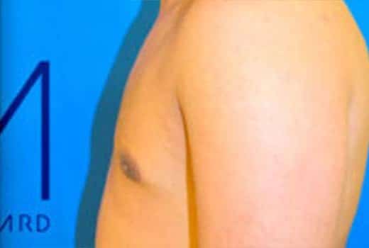 Poitrine d homme, vue de profil gauche apres gynecomastie | Dr Aimard Lyon