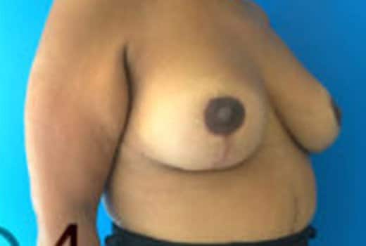 Seins de femmes, vue de profil face apres chirurgie du sein lifting mammaire | Dr Aimard Lyon