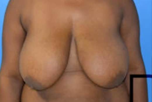 Seins de femme profil face avant reduction mammaire | Dr Aimard Lyon