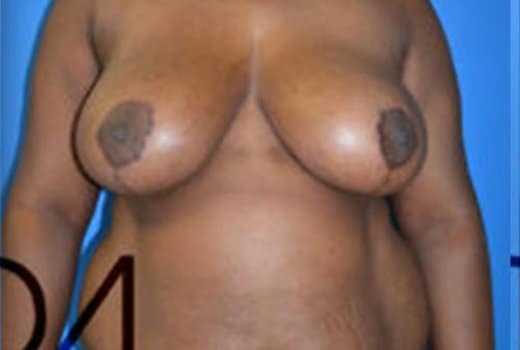 Seins de femme brune profil face apres reduction mammaire chirurgie du sein | Dr Aimard Lyon
