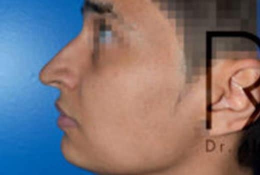 Visage d homme de profil gauche avant rhinoplastie. chirurgie esthetique et reparatrice | Dr Aimard Lyon