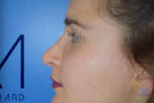 Visage de femme de profil gauche apres rhinoplastie chirurgicale | Dr Aimard Lyon