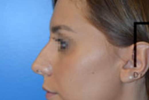 Visage de femme de profil gauche avant rhinoplastie chirurgicale | Dr Aimard Lyon