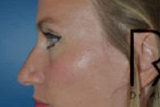 Visage de femme de profil gauche avant rhinoplastie chirurgicale | Dr Aimard Lyon