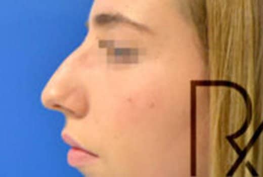 Visage de femme de profil gauche avant rhinoplastie chirurgicale | Dr Aimard Lyon