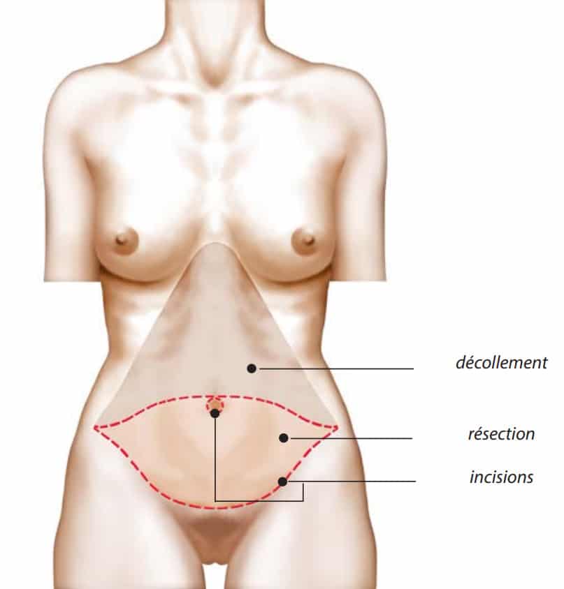Dessin du corps humain illustrant les partie du ventre pour Abdominoplastie | Dr Aimard Lyon