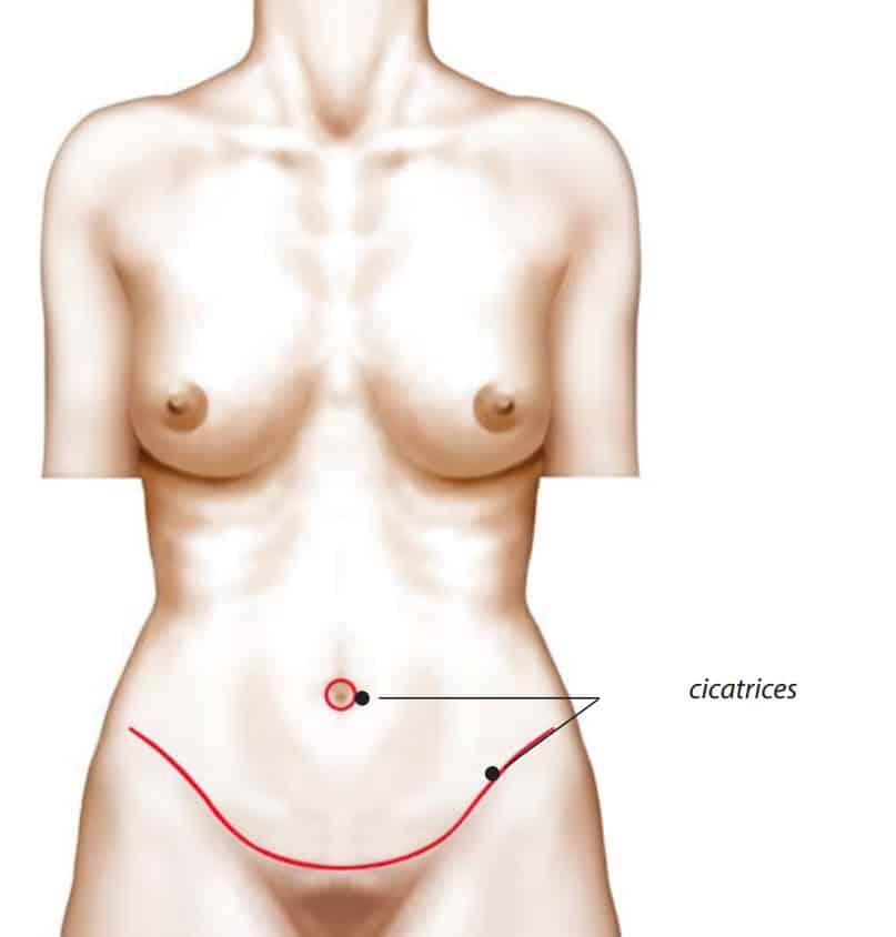 Dessin du corps humain illustrant les cicatrices de l Abdominoplastie | Dr Aimard Lyon