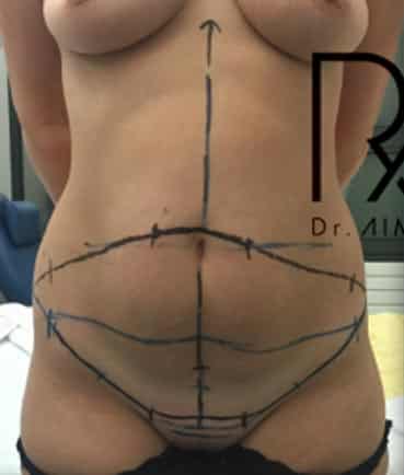 Ventre de femme avec traces sur le ventre pour abdominoplastie | Dr Aimard Lyon
