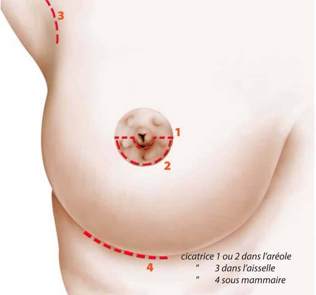 Dessin de sein de femme montrant les cicatrices pour augmentation mammaire par prothese | Dr Aimard Lyon