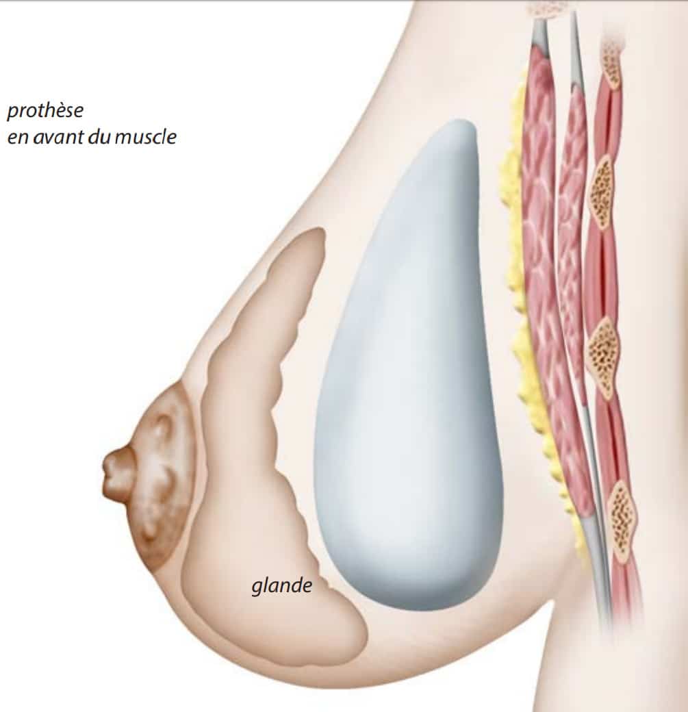 Dessin de sein de femme de profil gauche montrant l emplacement des protheses augmentation mammaire | Dr Aimard Lyon