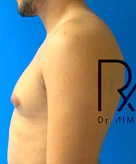 Torse d homme avant Gynecomastie reduction mammaire de l homme | Dr Aimard Lyon