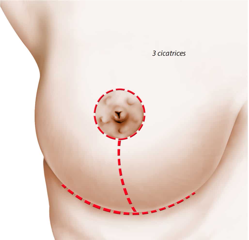 Sein de femme montrant les 3 cicatrices pour une reduction mammaire. hypertrophie | Dr Aimard Lyon