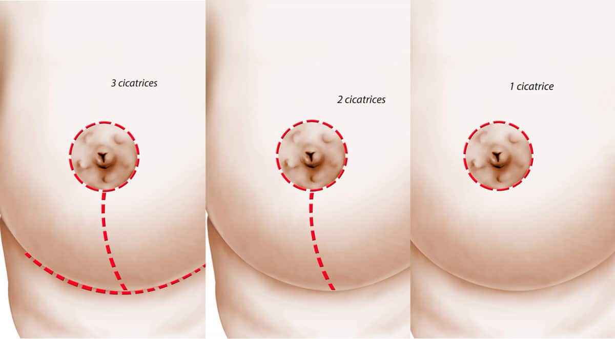 Dessin de sein montrant les trois cicatrices mastopexie lifting mammaire | Dr Aimard Lyon
