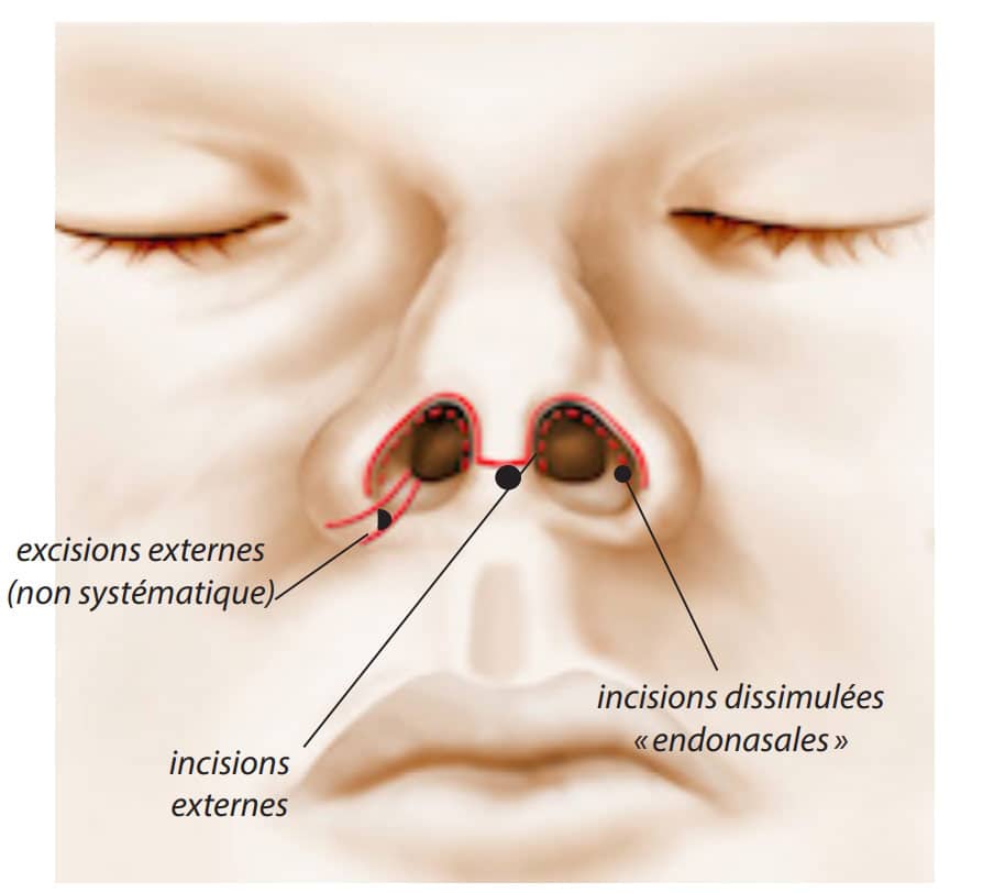 Dessin du nez profil bas montrant les zones des incisions pour rhinplastie chirurgie reparatrice | Dr Aimard Lyon